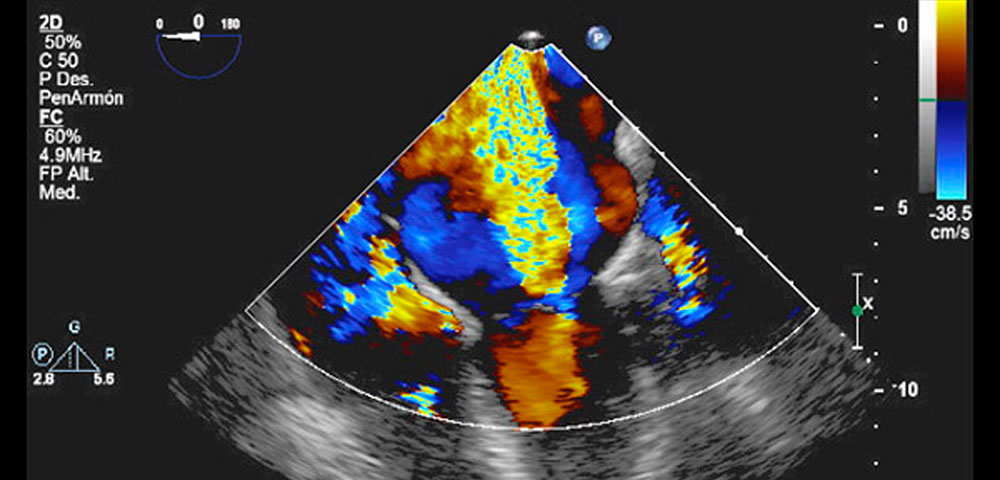 ecocardiograma 2d y doppler color