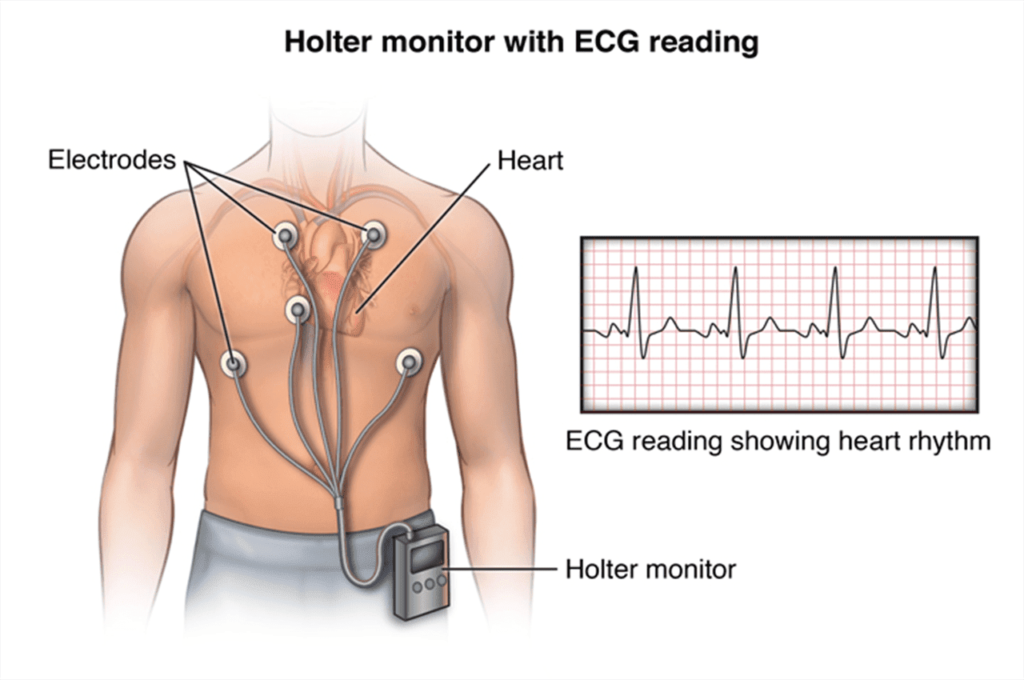 Holter de ECG